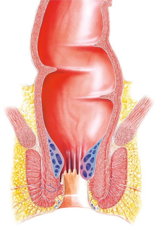 haemorrhoiden 1